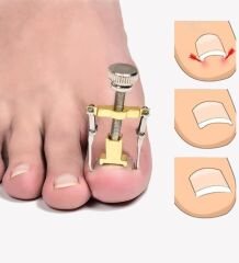 Batık Tırnak Düzeltme Aleti